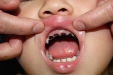 兒童牙齒矯正