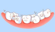 牙齿拥挤度有哪些分类