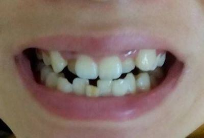 牙齿拥挤度有哪些分类