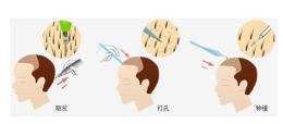 植发可不可以用身上其他地方的毛发来移植