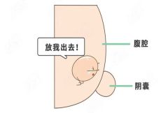 儿童隐睾